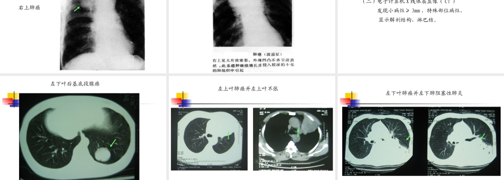 呼吸系统疾病原发性支气管肺癌医学教学课件.pptx
