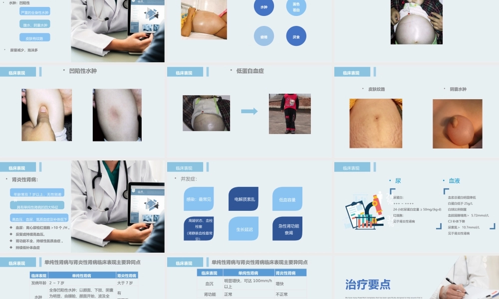 2022肾病综合征护理查房培训PPT课件（带内容）.pptx