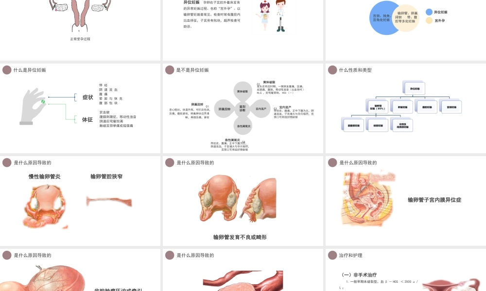 2022异位妊娠护理培训PPT课件（带内容）.pptx