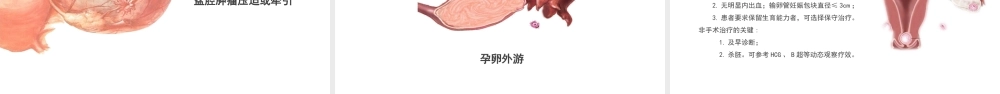 2022异位妊娠护理培训PPT课件（带内容）.pptx